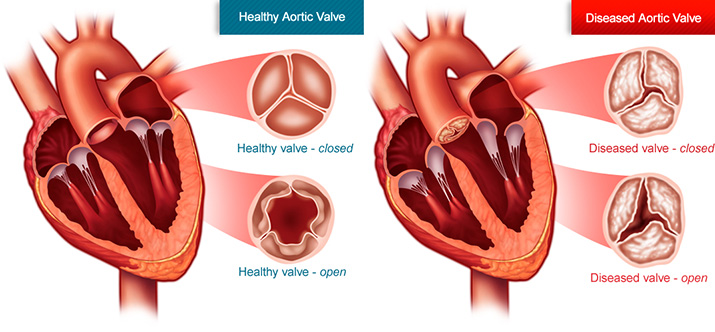 Aortic stenosis heart disease